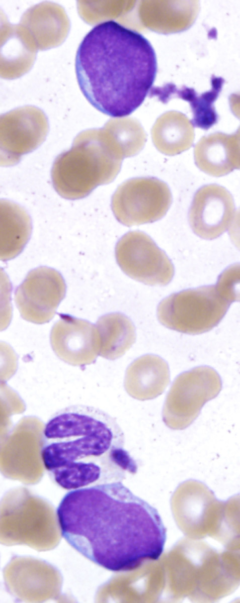 Fig 1E BMA 100x blasts and dysmyelopoiesis